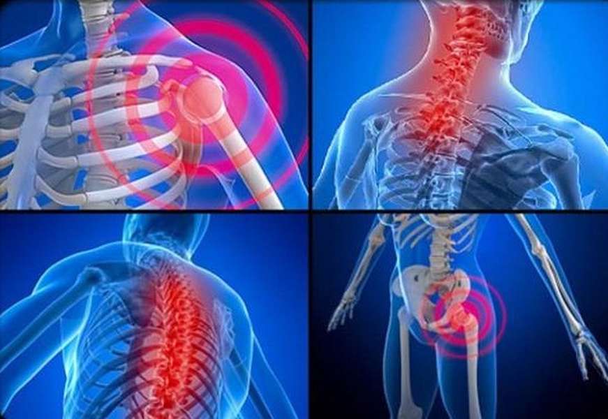 Fibromyalgia Syndrome - Hình ảnh minh họa